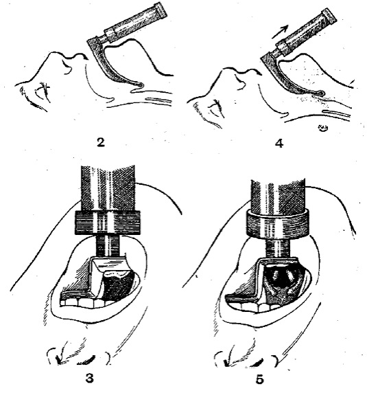 Laryngoscope Blade Macintosh (6 sizes available)