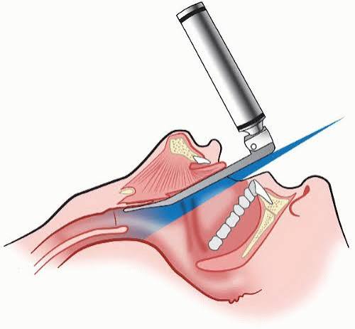 Laryngoscope Blade Miller (6 sizes available)